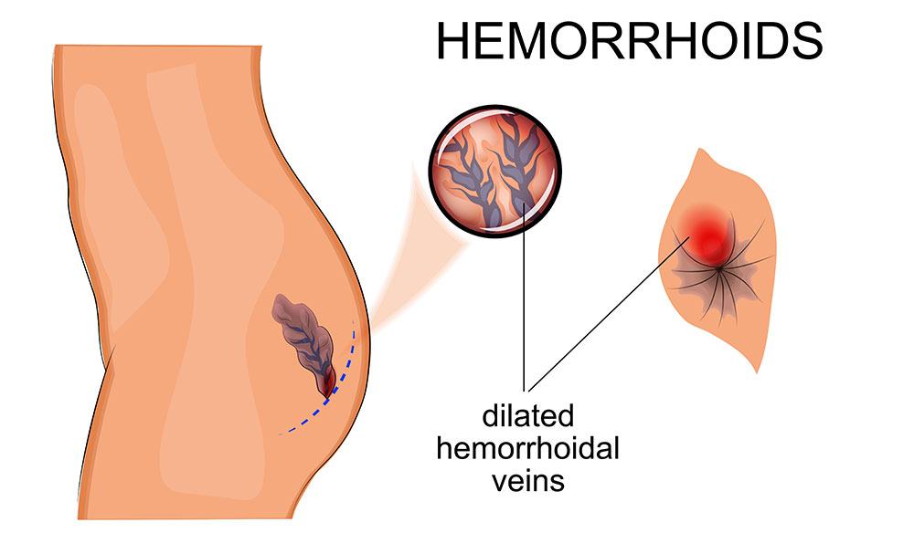hemorroides